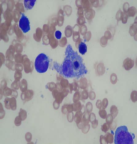 hemofagositik hücre (d)