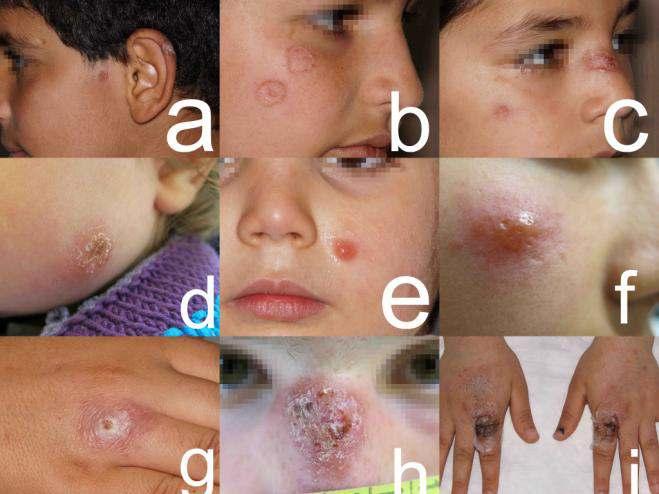 Figure 1: Clinical presentations of Old World cutaneous leishmaniasis.