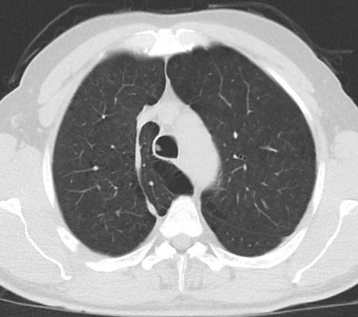 Literatürde, kronik duman inhalasyonu, astım, termal hasar, bronşektazi, yabancı cisim aspirasyonu ve titanyum tetraklorür hasarı ile ilişkili endobronşiyal fibroepitelyal polip vakaları