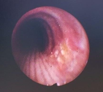 Fibroepitelyal polipler ciltte, uterusda ve boyunda yaygın görülen benign lezyonlardır. Trakeobronşiyal ağaçta seyrek görülen nadir vaka bildirimleri mevcuttur (3,7,8). Resim 3. Resim 4. Resim 5.