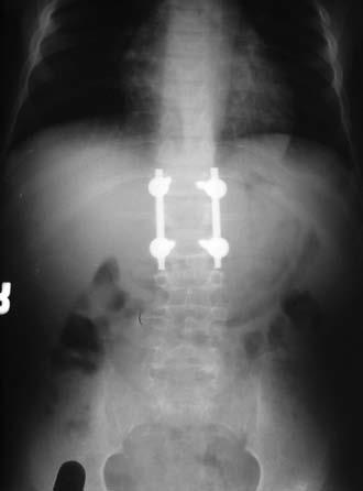 4 yaşında Tip 1 konjenital kifoz posterior hemivertebra