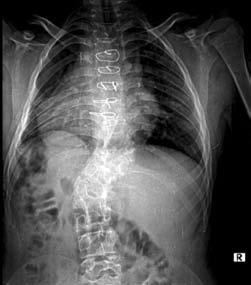 Konjenital kifoz olgularında sadece posterior yaklaşım ile vertebral kolon rezeksiyonu