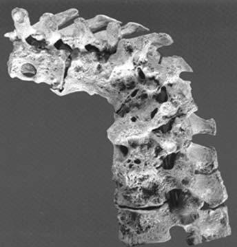 Şekil-1. Mısırda bulunan bir mumya omurgası, Pott sonrası oluşan kifotik deformite görülüyor. Şekil-2.