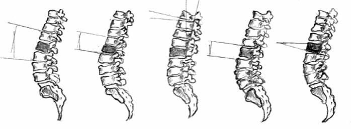 Şekil-1. Kuklo ve arkadaşlarıadaşlarına göre torakolomber burst kırığı sonrası lateral grafide sagital deformiteyi ölçmenin 5 yöntemi.