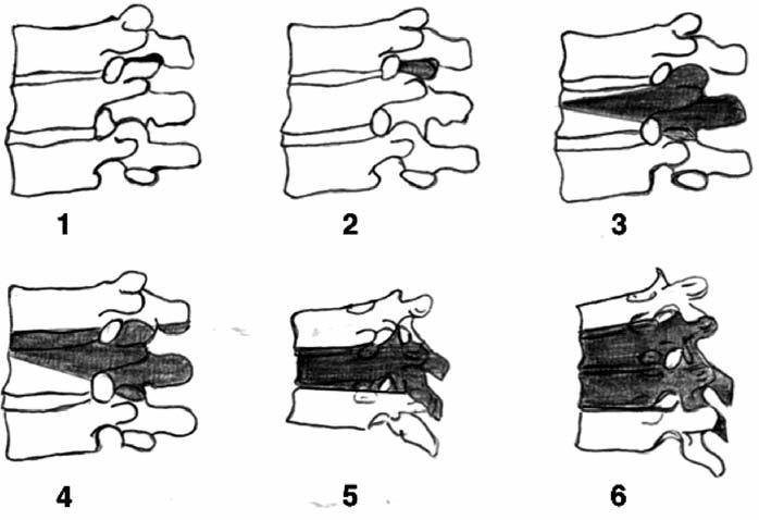 Şekil-17. Osteotomilerin evreleri; Evre-1. Parsiyel faset eklem rezeksiyonu, Evre-2. Faset eklemin tam rezeksiyonu, Evre-3. Pedikülün tam, vertebra cisminin parsiyel rezeksiyonu, Evre-4.