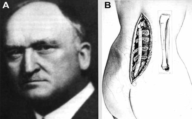 W. F. Wilkins (1848-1935) Kansas da ilk vertebral internal fiksasyonu yapan kişi olarak kayda geçmiştir (Şekil-10) (20,37). Edward Bradford Boston da 1897 de ilk skolyoz kliniğini kurmuştur.