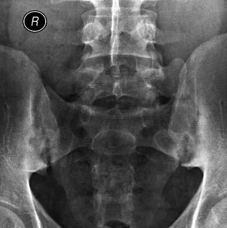 Hastalığı, monositler ve osteoklastların indüklediği bir inflamatuar atağın başlattığı, bu atak sonucunda kemik ve eklem kıkırdağında erozyon ve destrüksiyon oluştuğu ve bu destrüksiyonun fibröz doku