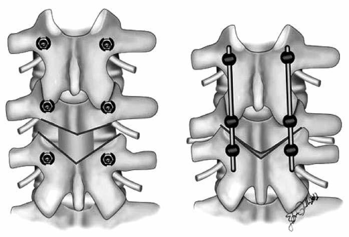 kifotik deformiteler için multi-seviye PO önerilmiştir.