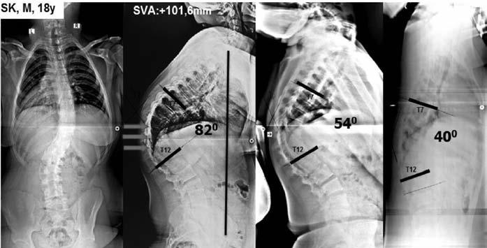 Fleksibilite grafilerinde rezidüel kifoz ve mobil diskleri olan bir 18 yaşındaki bir kifoskolyoz hastasında 3 seviyeli asimetrik Ponte osteotomisi ile düzeltme.