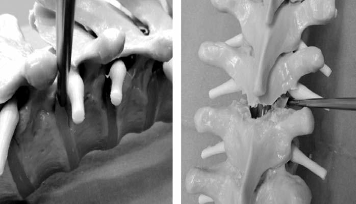 PEDİKÜL SUBTRAKSİYON OSTEOTOMİSİ Pedikül subtraksiyon osteotomisi (PSO) ilk olarak Thomasen tarafından 1985 yılında tarif edilmiş transpediküler olarak V şeklinde kama tipi bir osteotomidir.