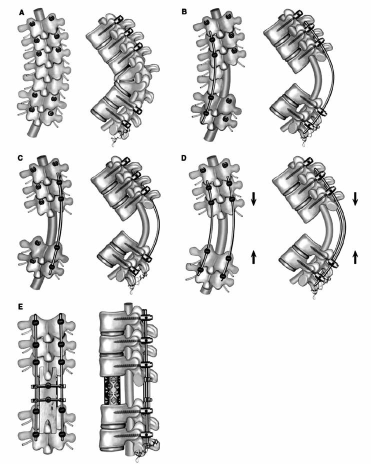 Şekil-20. Posterior vertebral kolon rezeksiyonu (PVKR).