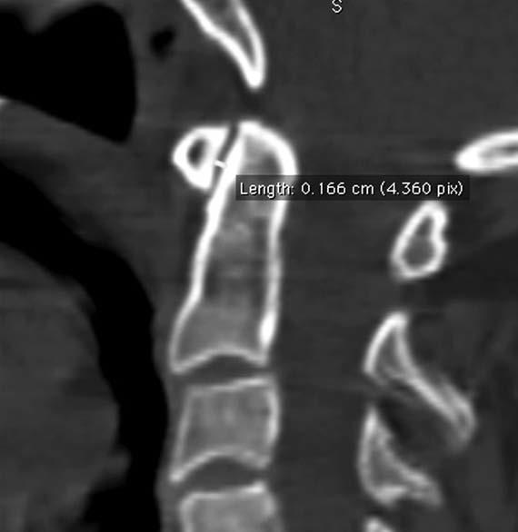 Resim-2. Bilgisayarlı tomografi rekonstrüktif sagital kesit atlantodental aralık ölçümü ADI in normal değerleri erişkinlerde 3mm ve altı, çocuklarda ise 5 mm ve altıdır (1).