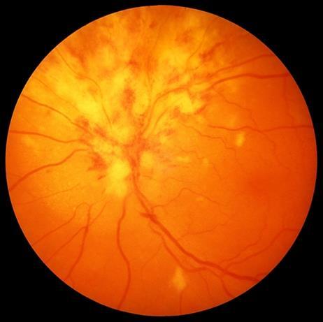 CMV retiniti Tüm katları