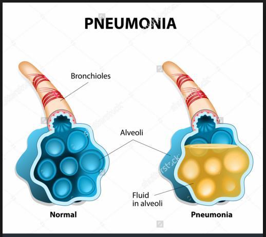 Akciğer dokusunun inflamasyon ve İnfeksiyonu (Pnömonitis/Pnömoni) Mikroorganizmaların akciğerlere ulaşması ve çoğalması sonucu oluşan yangısal süreç Mikroorganizmalar akciğere; Orofaringeal