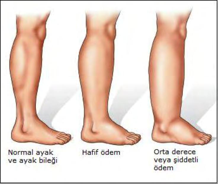 Hipervolemi Belirtileri Nelerdir?