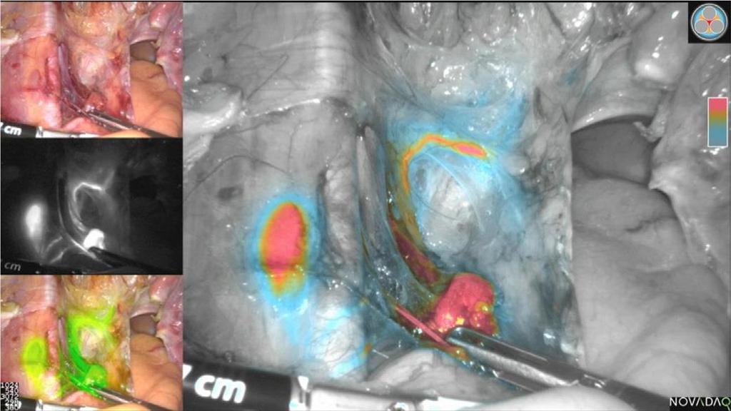 Example of left pelvic sentinel lymph node (SLN) following indocyanine green (ICG) cervical injection in endometrial cancer. The lymphatic trunk, SLN, and secondary node are seen.