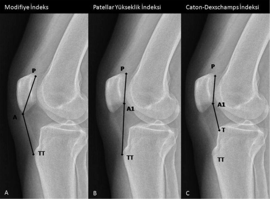 Patellar Maltracking: Dizin hareketi esnasındaki patellofemoral uyumsuzluğa verilen isimdir.