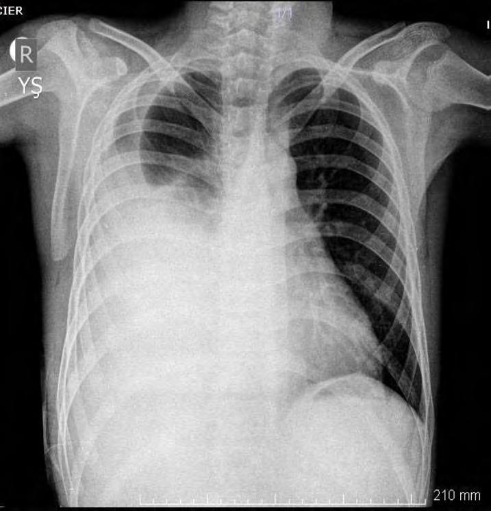 Hidrotoraks Artmış intraabdominal basınç, küçük ve sıklıkla konjenital diyafragmatik defekt