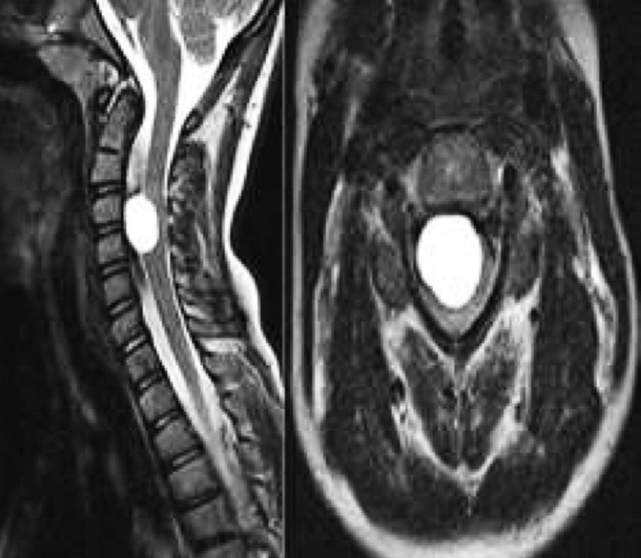 bölgede, ventral yerleşimli ve intradural spinal araknoid kistler ise literatürde oldukça az raporlanmıştır.