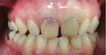5 Özellikle travmaya maruz kalan ve kök kanal tedavisi yapılan dişlerde meydana gelen renk değişiklikleri önemli estetik problemlere yol açmaktadır.