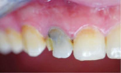 Hasta kanal tedavisinden bir iki ay sonra dişte renklenme meydana geldiğini belirtti ve kanal tedavisinden yaklaşık iki yıl sonra dişin kırıldığını söyledi (Resim 5).