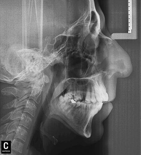 RESİM 2: Sınıf II iskeletsel bozukluk ve ön açık kapanışı olan hastanın ağız içi görüntüsü. TABLO 1: Hastanın sefalometrik bulguları.