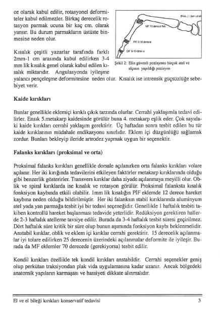 ce olarak kabul edilir, rotasyonel deformiteler kabul edilmezler. Birkaç derecelik rotasyon parmak ucuna bir kaç cm. olarak yansır. Bu durum parmakların üstüste binmesine neden olur.