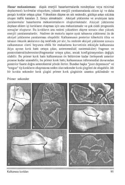 Hasar mekanizması: düşük enerjili hasarlanmalarda nondeplase veya minimal deplasma nl ı kırılmalar oluşurken; yüksek e neıjili yaralanmalarda eklem içi ve daha parçalı kırıklar ortaya çıkar.