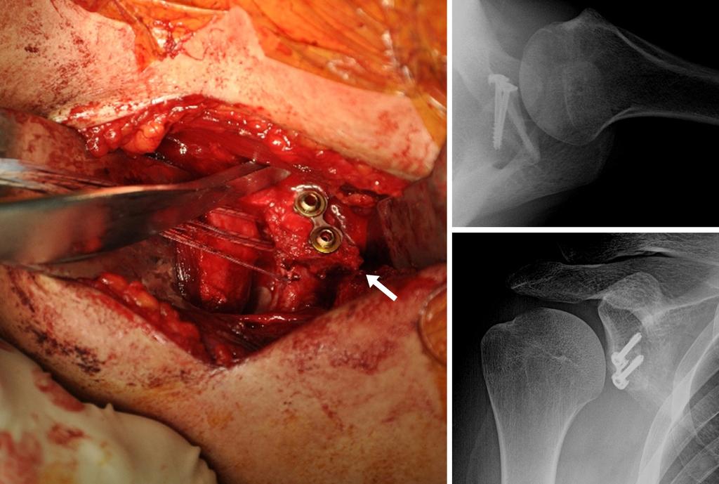 318 TOTBİD Dergisi (a) (b) (c) Şekil 6. a c. Korakoid greftinin glenoid ön yüzüne plak ve 2 vida ile tespiti (a). Aynı hastanın ameliyat sonrası aksiller (b) ve gerçek AP (c) grafileri.