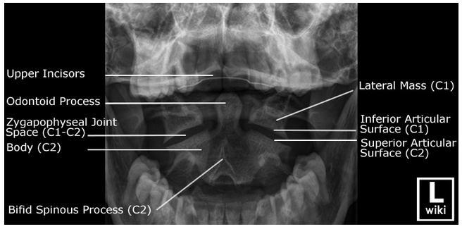 Odontoid