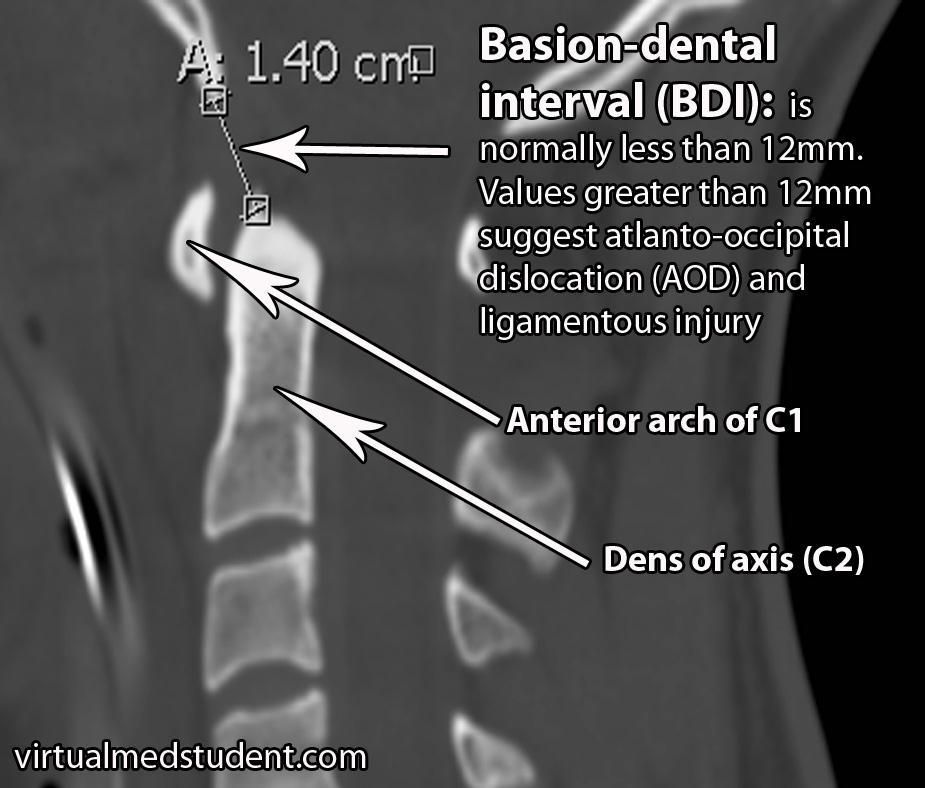 C2- oksiput bileşkesi Basiodental mesafe: <