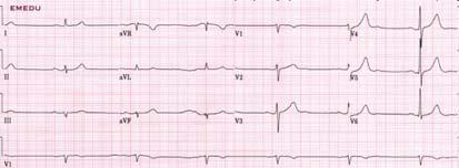 AV Block, Sinus