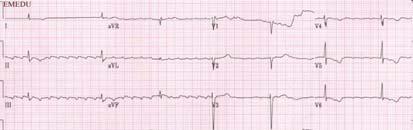 Fibrillation with slow