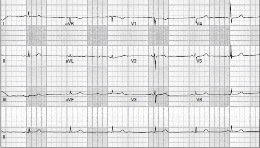 SB, rate 40 Sinus