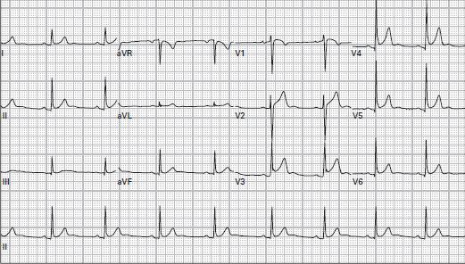 rate 50, LVH,