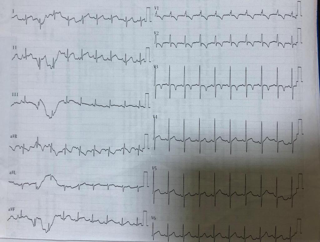 EKG Ritim; sinüs Nabız; 110/dk (ritmik) QRS aksı; normal