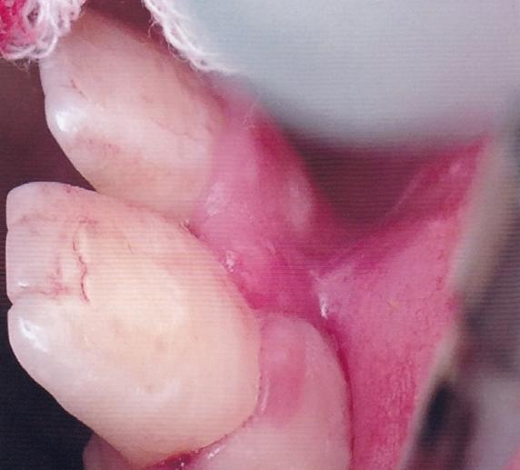 Dişin normal oklüzyona gelmesini takiben yumuşak doku sütürlenerek dört hafta süre ile esnek bir tel (0,4 mm) ile splintleme