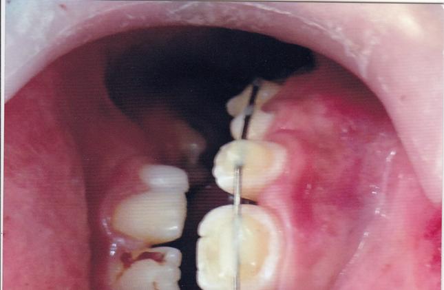 Cerrahi ekstrüzyon sonrası dişte mine-dentin kırığı olduğu anlaşıldı ve kanal tedavisi sonrası diş kompozit ile restore