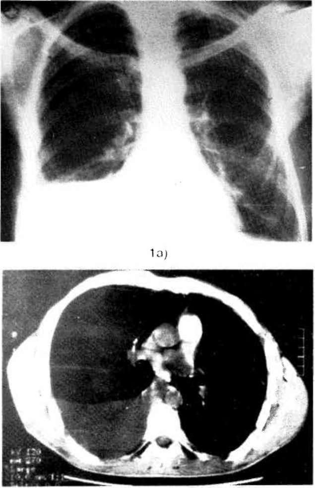 426 1b) Şekil 1. a) PA akciğer grafi ve b) BT incelemesinde her iki akciğer alanı doğaldır. Sağda plevral efüzyon izlenmektedir [Plevra sıvısında ARB (+)]. Sol kostodiafragmatik sinüs kunttur.