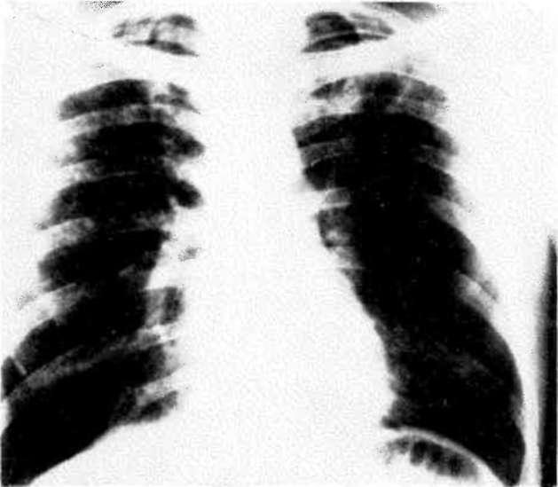 TANISINDA GÖRÜNTÜLEME Akciğer röntgenogramı en yaygın kullanılan ve en önemli inceleme yöntemidir. Bilgisayarlı tomografi de kesitsel anatomiyi ayrıntılı olarak göstererek tanıda etkilidir.