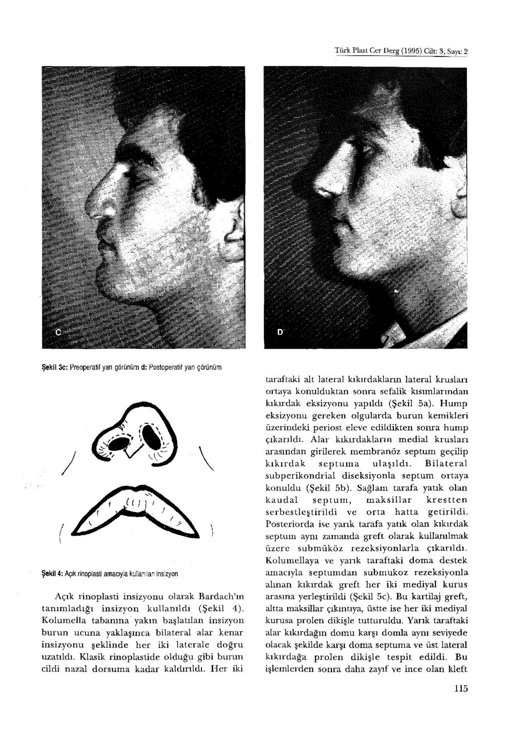 Türk Plast Cer Derg (1995) Cilt: 3, Sayı: 2 Şekil 3c: Preoperatif yan görünüm d: Postoperatif yan görünüm Şekil 4: Açık rinoplasti amacıyla kullanılan insizyon Açık rinoplasti insizyonu olarak B