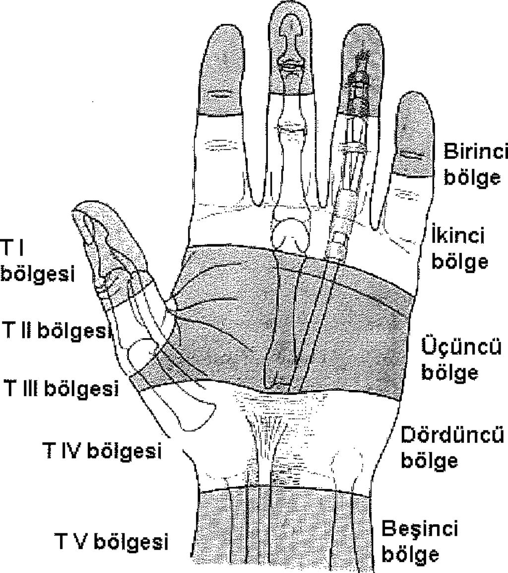 ) Şekil 4: Fleksörtendon yaralanmalarında prognostîkfaktörler gözönüne alınarak planlanmış beş anatomik bölge (Verdan'ın Anatomik Sınıflaması) (Kaynak 8rden modifiye edilmiştir.