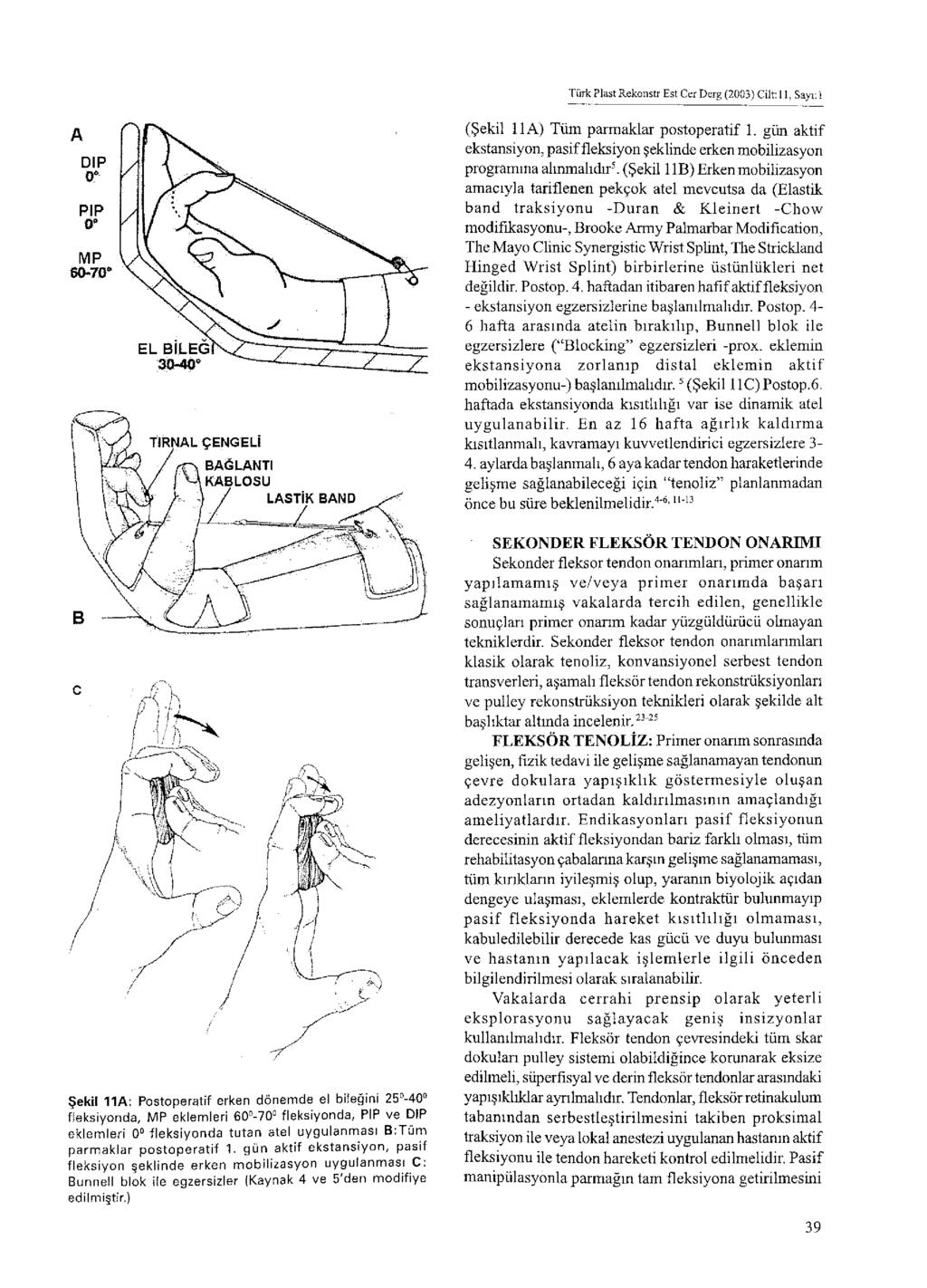 Türk Plast Rekonstr Est Cer Derg (2003) Cilt: 11, Sayı: 1 (Şekil 11 A) Tüm parmaklar postoperatif 1. gün aktif ekstansiyon, pasif fleksiyon şeklinde erken mobilizasyon programına alınmalıdır5.