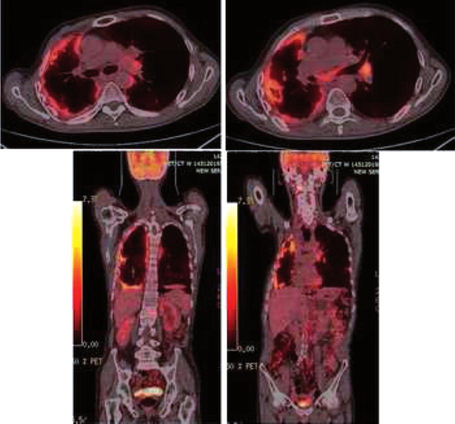 RESİM 3: Florodeoksiglukoz pozitron emisyon tomografi bilgisayarlı tomografi taramasında kostal, mediastinal ve diyafragmatik plevral yüzeylerde heterojen tarzda patolojik artmış florodeoksiglukoz