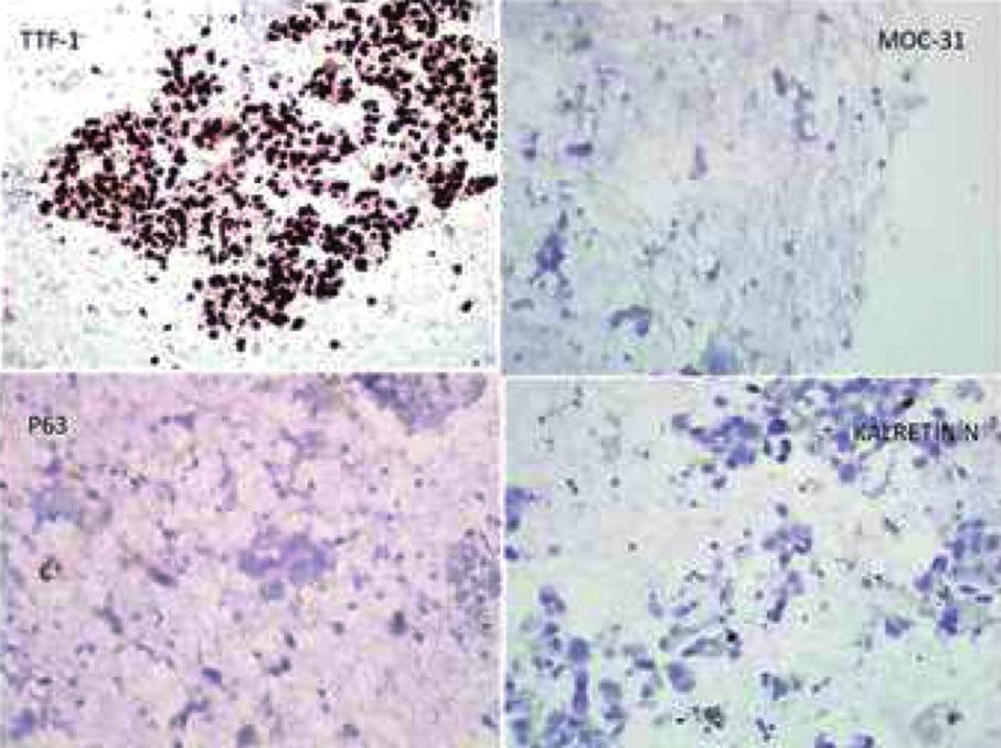 Hazırlanan hücre bloklarının histopatolojik incelemesi adenokarsinom ile uyumlu olarak saptandı. İmmünohistokimya çalışmasında kalretinin, sitokeratin 5/6, p63 ve trombomodulin negatif idi.