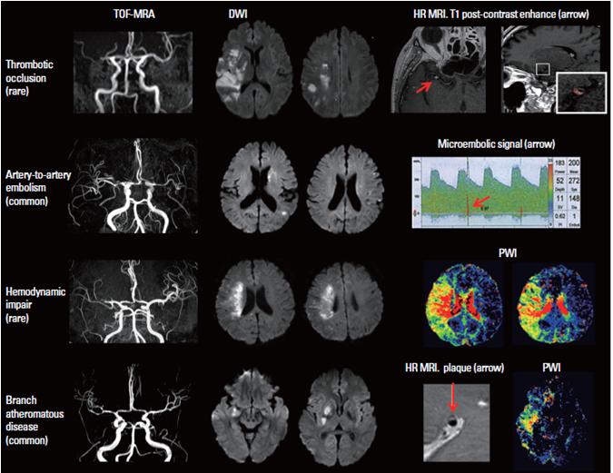 ICAD ile ilişkili inme mekanizmaları 1 Hipoperfüzyon 2 Arterden artere emboli 3 Aterom Dal hastalığı (plağın küçük penetran arterin ağzına doğru genişlemesi) 4