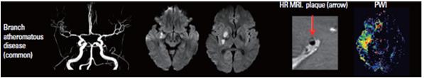 infarkt Mekanizma: Perforan arterin ya da arterlerin orifislerinin tıkanması Posterior circulasyonda daha sık ICAD da inme de farklı mekanizmalar mevcuttur.