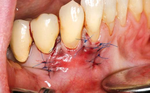 mucoderm in Üç ay sonraki klinik durum