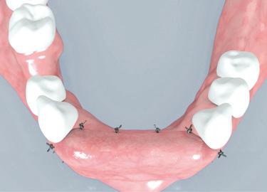 Transplantasyondan altı ay sonra kemik plakasında yüzeysel bir rezorbsiyon görülebilir; ancak sağlamlık korunur.