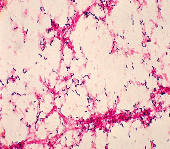 OLGU; Dr.Umut Kalyoncu 1941 doğumlu,erkek,2011 RA:Etanersept, hidroksiklorokin +düşük doz steroid 2012: Rituksimab+leflunomid KAH,Sigara Rituksimab 2.